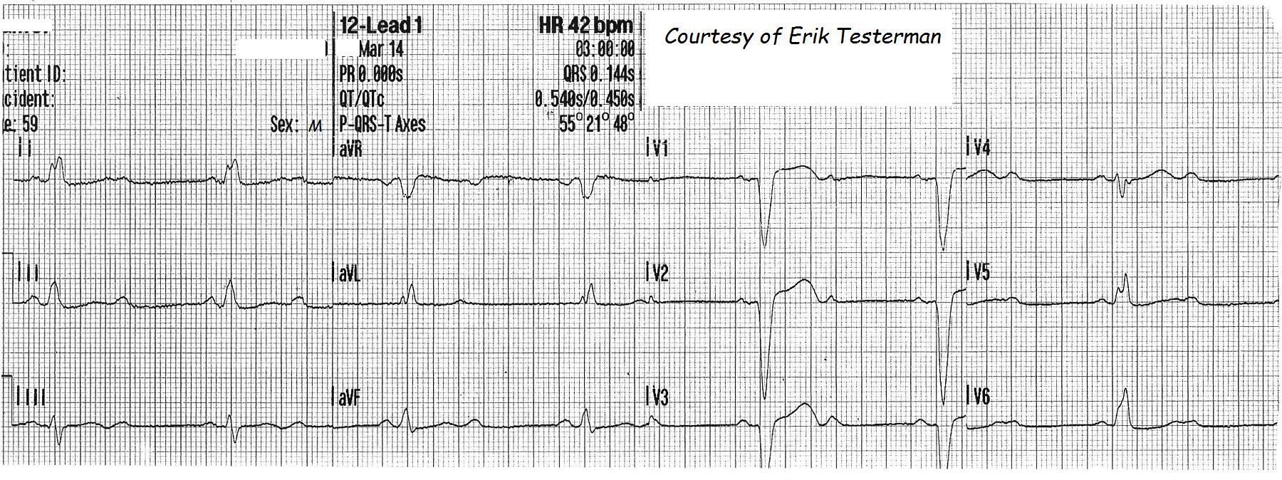 2nd-degree-av-block-rhythm-strip